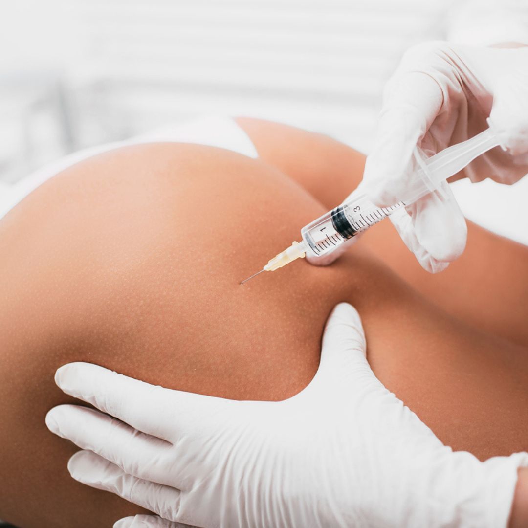 Redrapage du fessier sans chirurgie