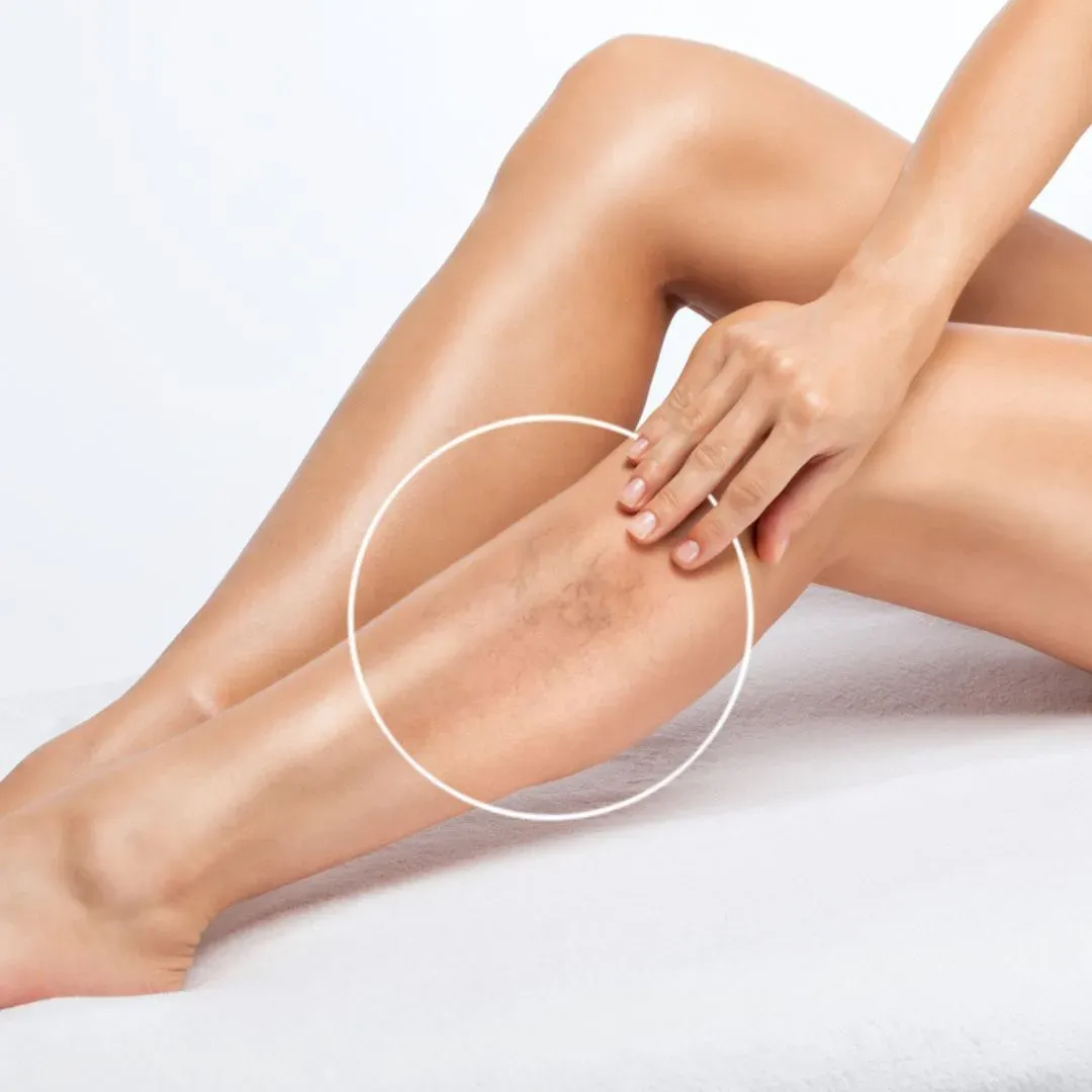 Spider Vein Treatment