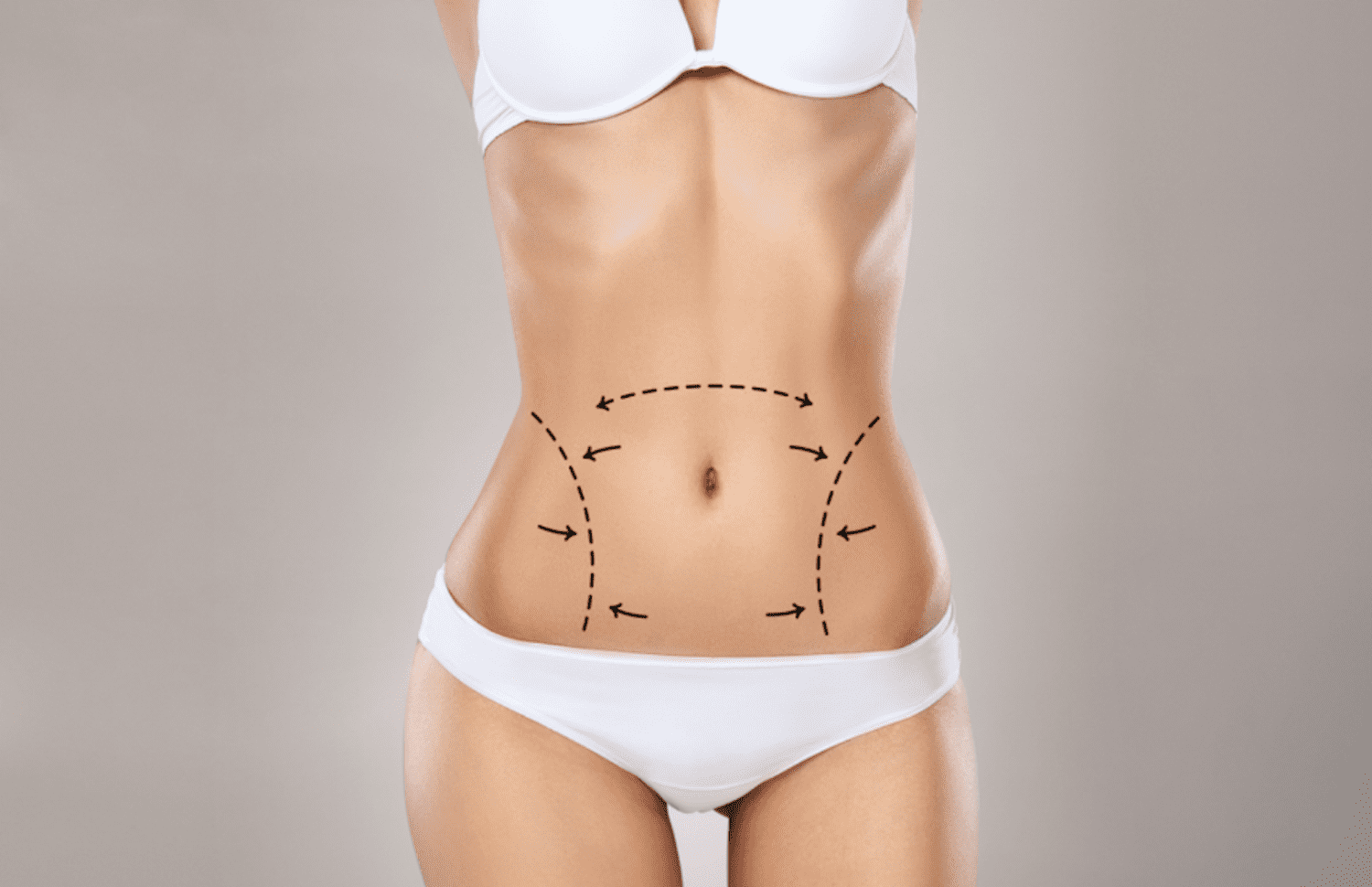 Abdominoplastie