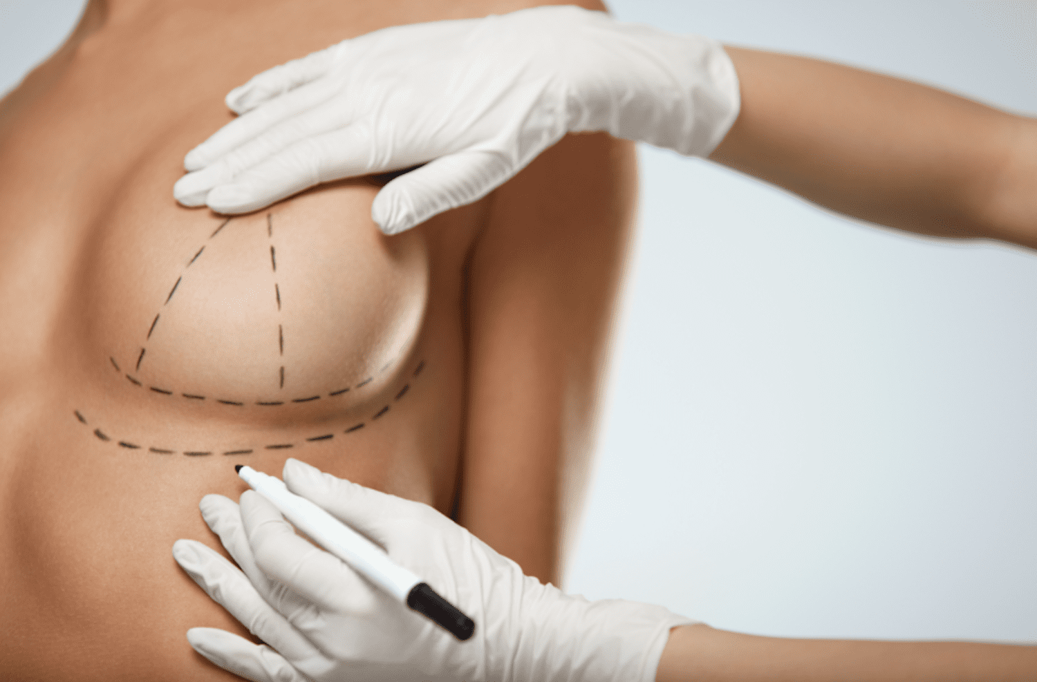 Réduction mammaire