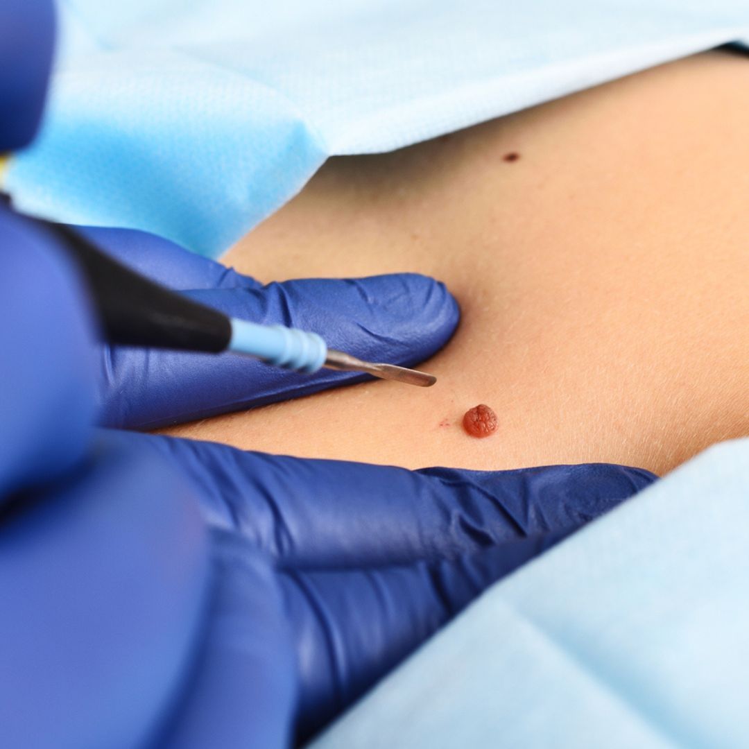 Traitements des grains de beauté, lipomes et kystes
