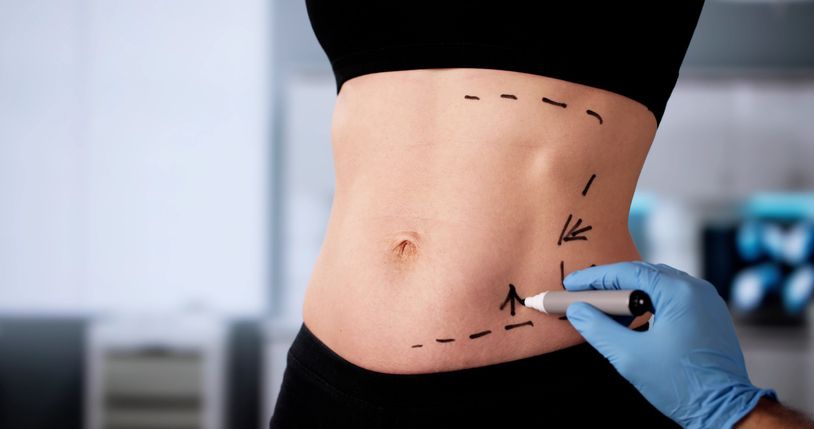 Abdominoplasty