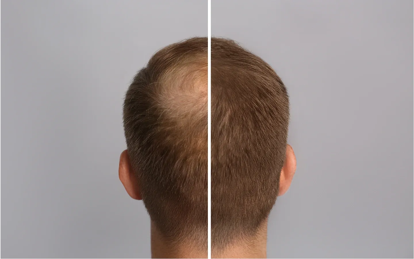 Hair Transplant